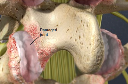 Close-up illustration of a spinal vertebra with a labeled damaged joint, showing rough, red, irritated areas on the bone surface and surrounding cartilage.