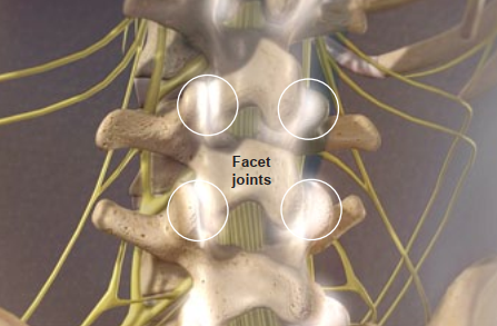 Diagram of the spine showing facet joints, highlighted by four white circles along the vertebrae, with nerves and other spinal structures visible in the background. The label Facet joints is centered in the image.