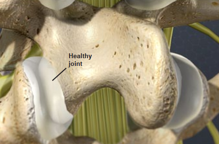 Close-up illustration of a healthy spinal joint with smooth, intact bone and cartilage surfaces. A label points to the joint, highlighting its healthy condition.